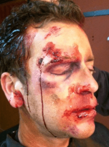 Pincotte  after his beating